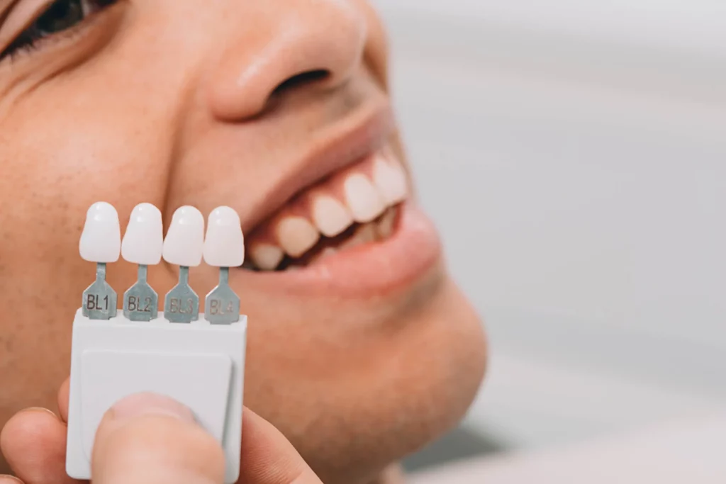 Facings vs kronen: wat is het verschil?